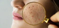 Advanced Acne Management and BLU U Acne Therapy